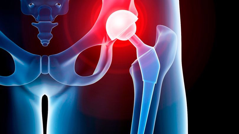 prod-human-hip-replacement-illustration-e1498989624192.jpg